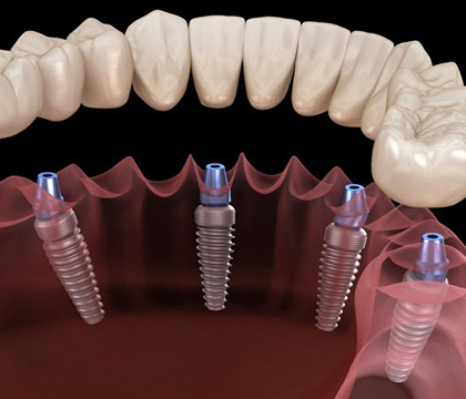 All-on-4 Implants In Glendale, AZ