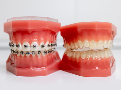 Dental Braces