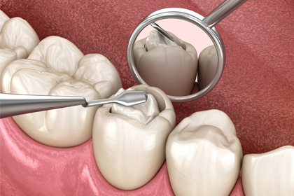 Dental Fillings in Glendale, AZ
