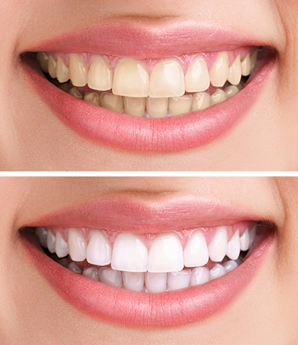 Professional Teeth Whitening