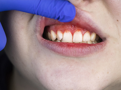 Gum Disease Treatment