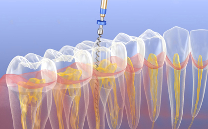 Root Canal Treatment