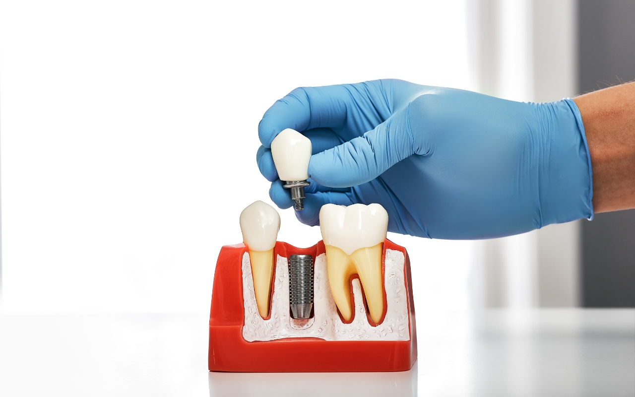 Zygomatic Dental Implants: Solution for Severe Bone Loss