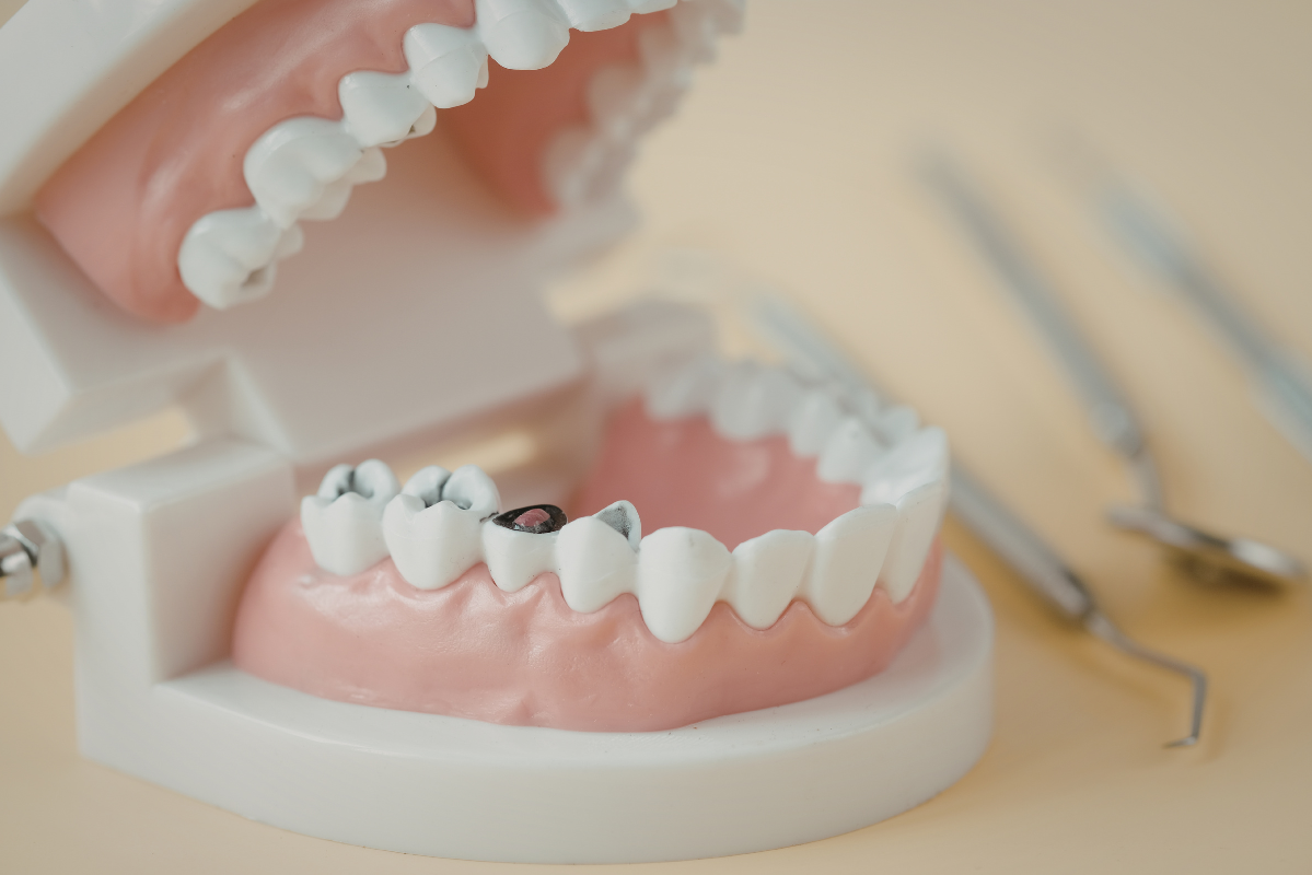 Why Dental Implants Cost More Upfront but Save Money Long Term